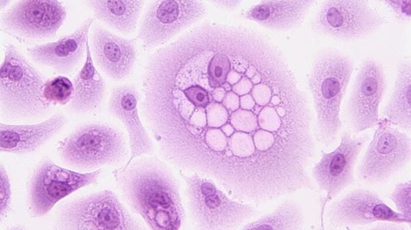 Cellule che si muovono in gruppo punto debole del tumore al seno 