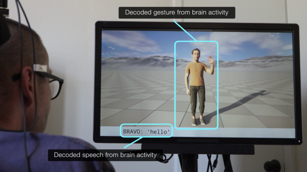 Un impianto cerebrale traduce gesti e parole in persone paralizzate 