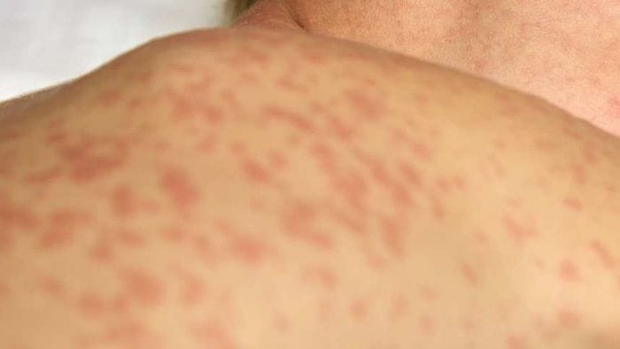 morbillo i pediatri una persona pu242 contagiarne 17 da Ecodibergamo.it morbillo i pediatri una persona pu242 contagiarne 17
