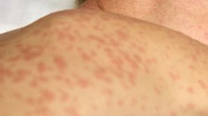 Morbillo, i pediatri: «Una persona può contagiarne 17»