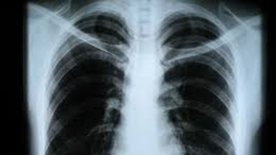 «Papa Giovanni», immagini radiologiche disponibili nel Fascicolo sanitario