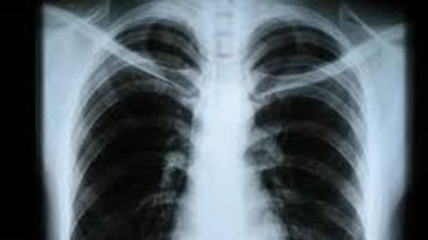 «Papa Giovanni», immagini radiologiche disponibili nel Fascicolo sanitario